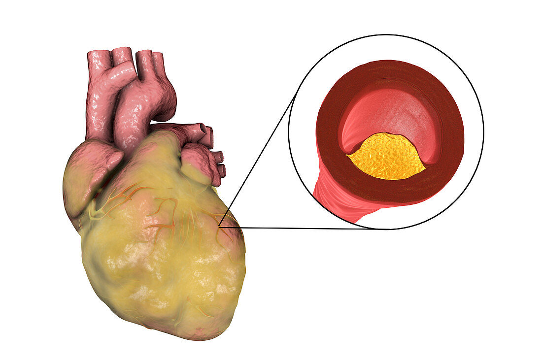 Heart disease,illustration