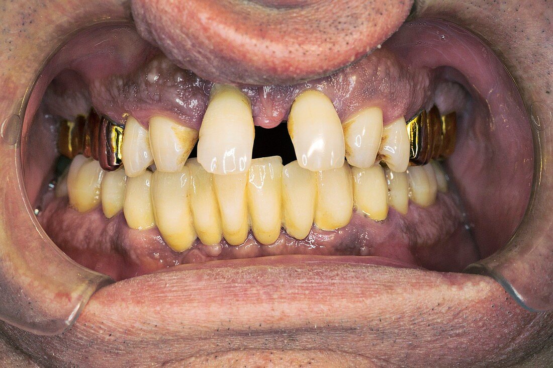Curved front teeth