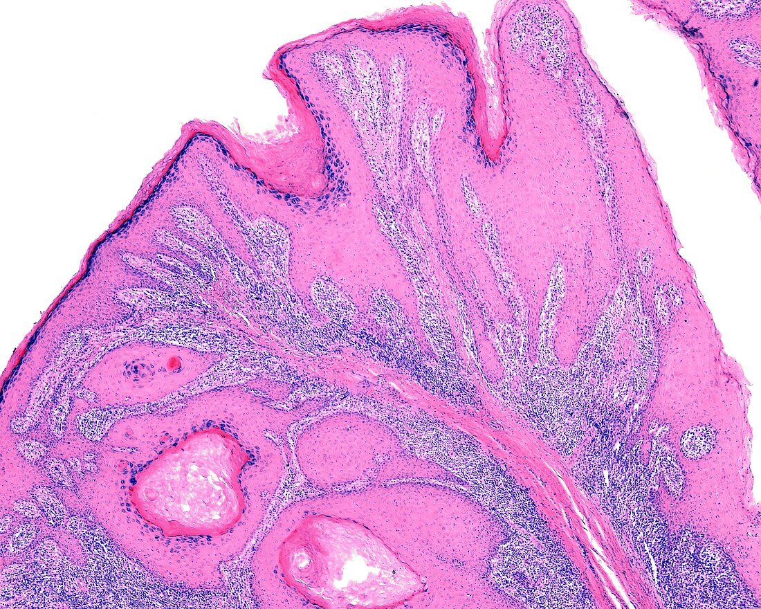 Papilloma, light micrograph