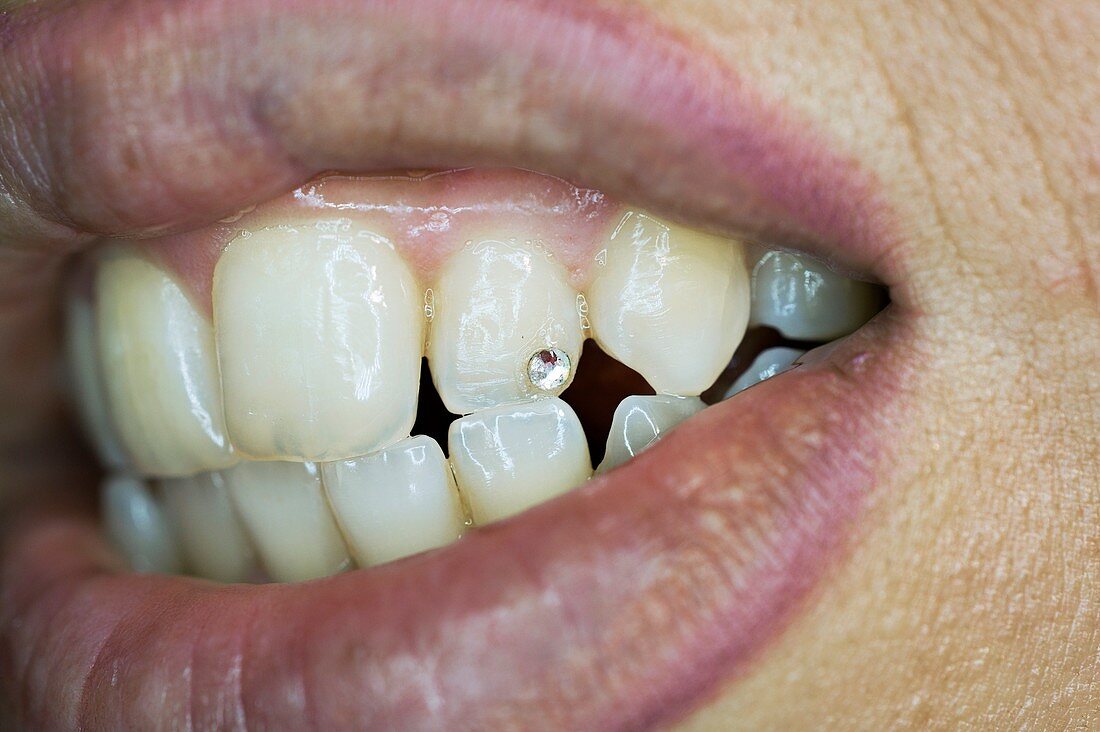 Diamond tooth gem