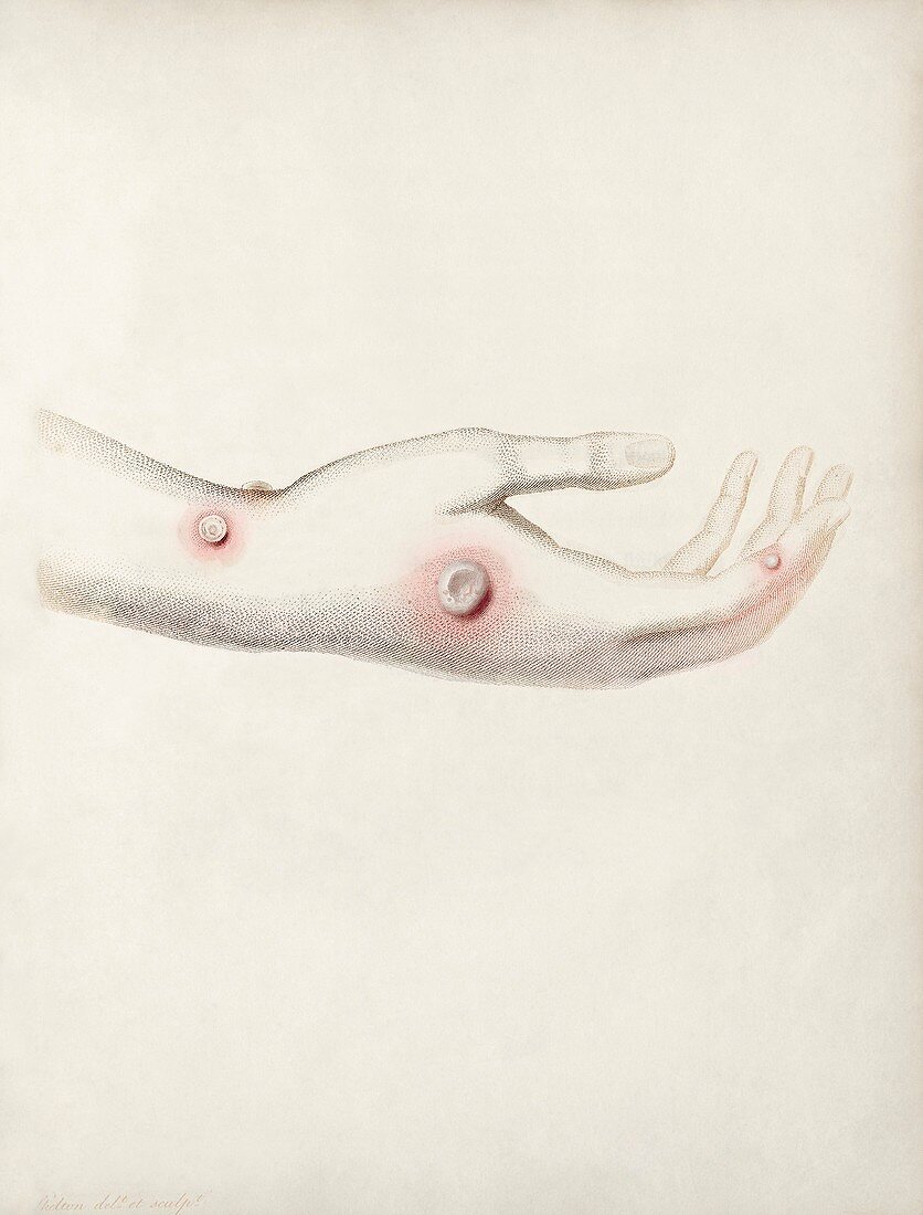Cowpox, illustration from Edward Jenner's book