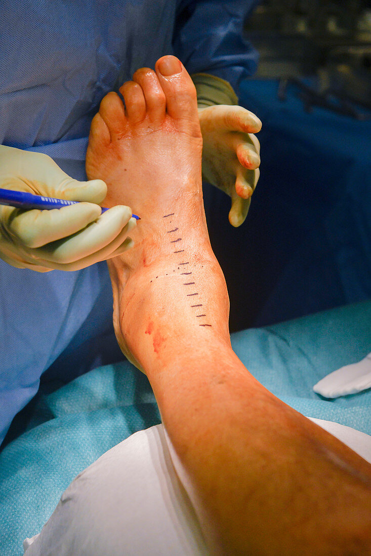 Total ankle replacement surgery