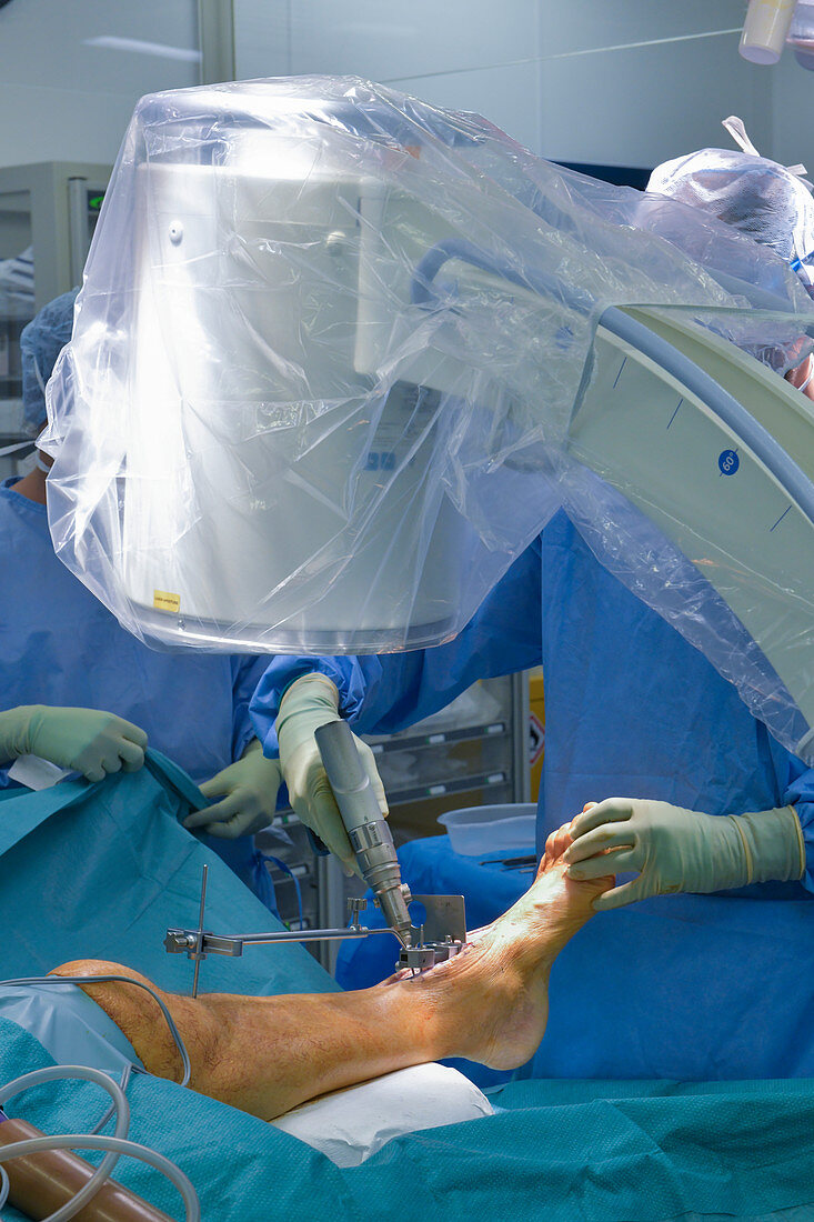 Total ankle replacement surgery
