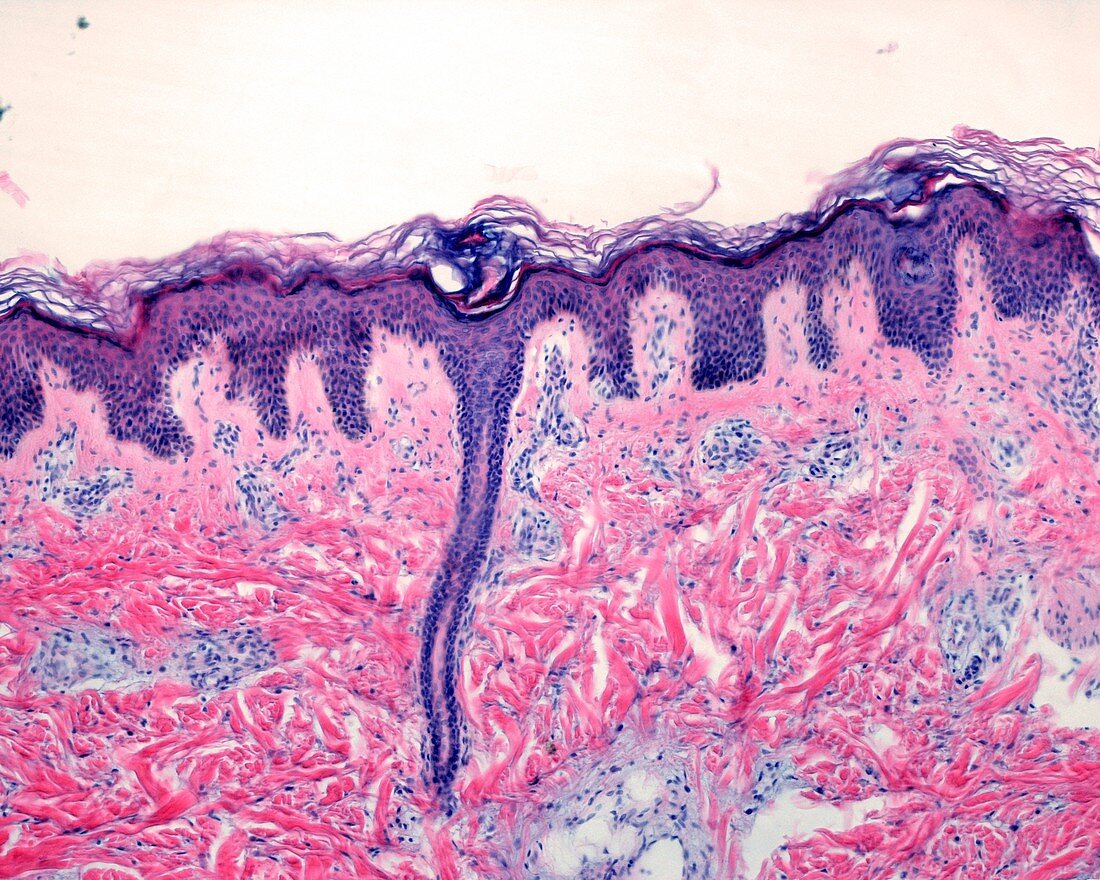 Fibroma of the skin, light micrograph