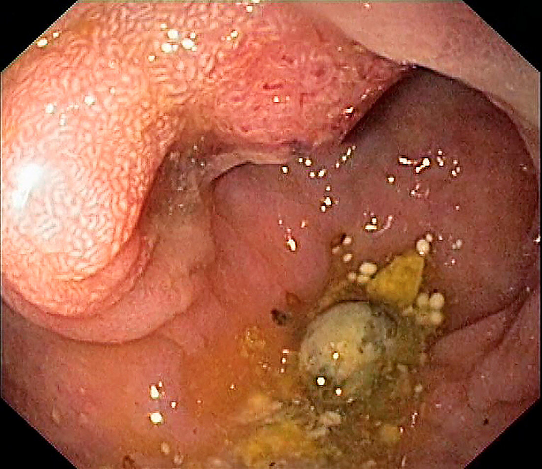 Colon cancer, endoscope view