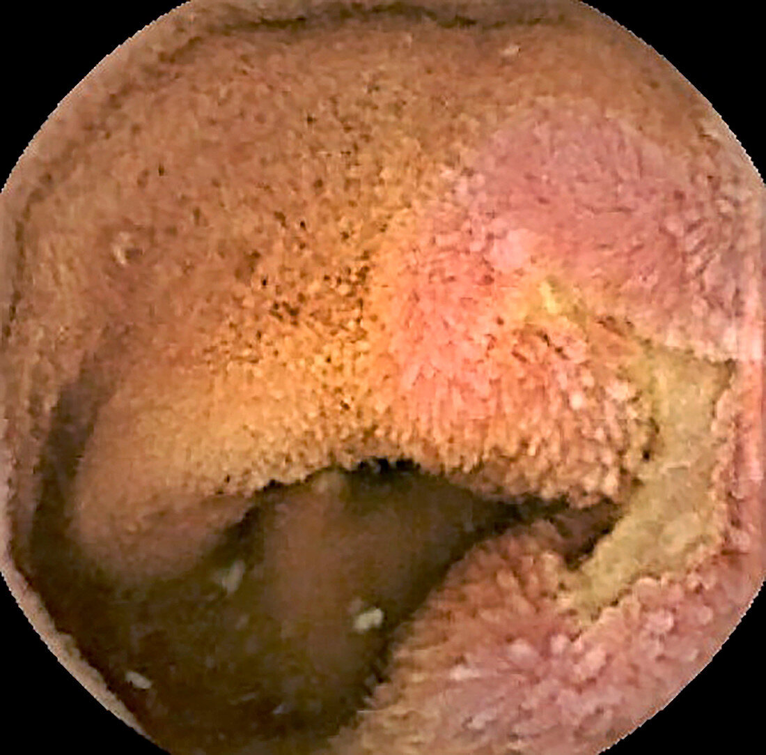 Small intestine in Crohn's disease, pill camera view