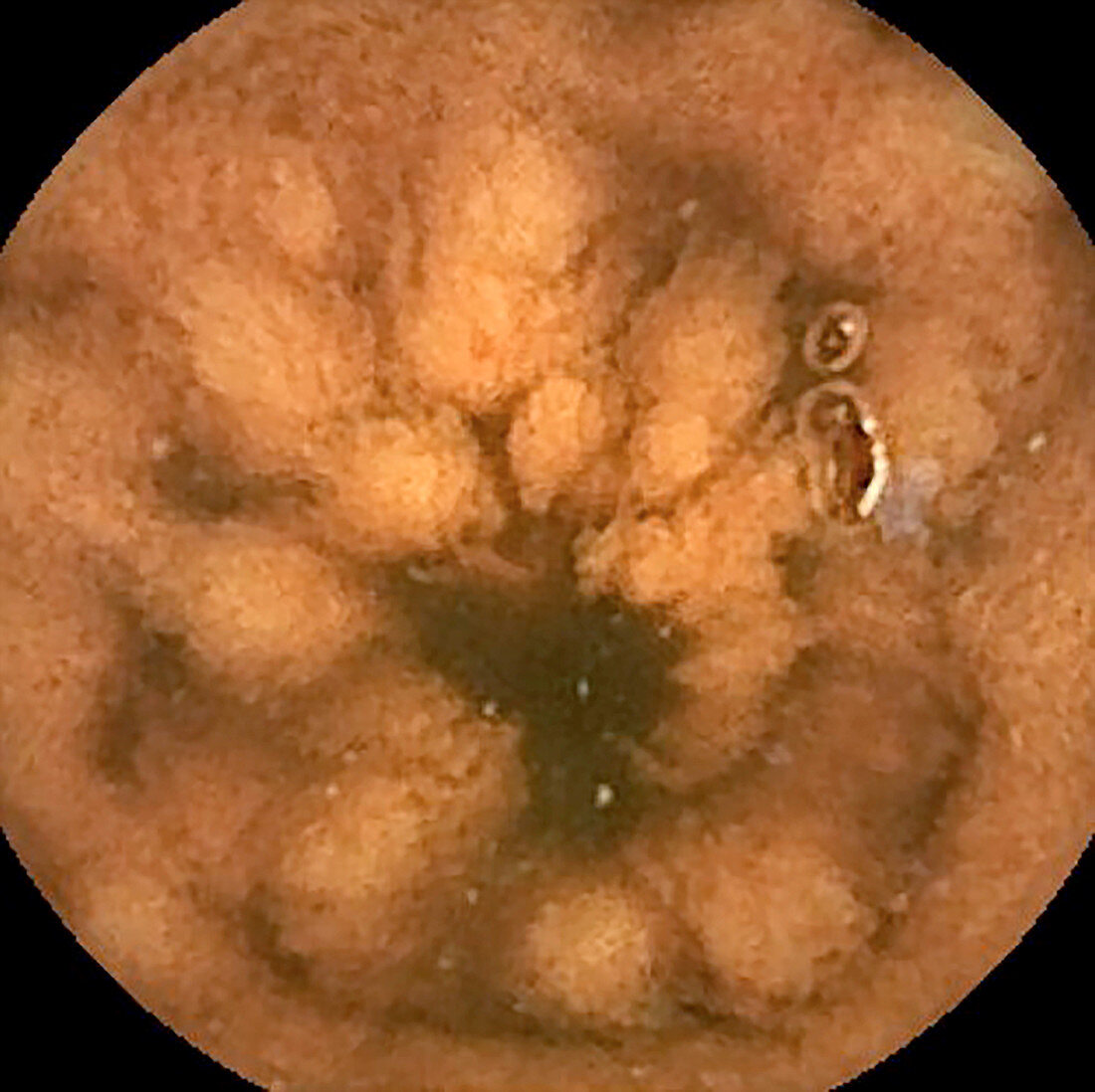 Intestinal lymphoid hyperplasia, pill camera view