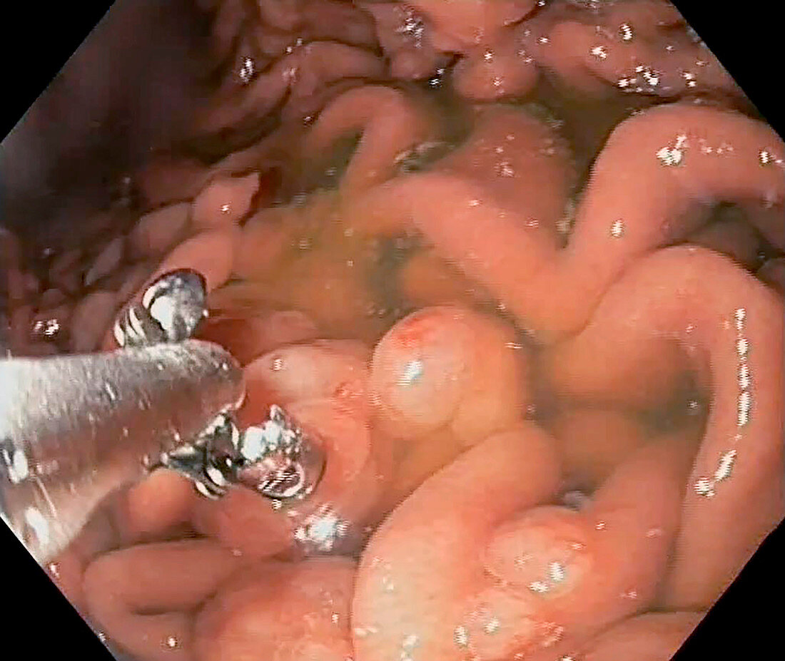 Hyperplastic polyps in the stomach, endoscope view