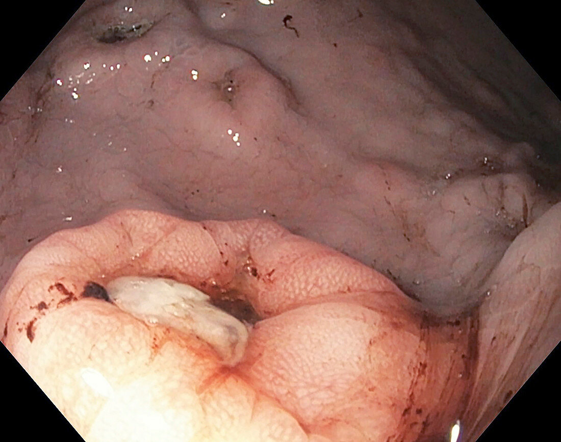Ulceration in gastric lymphoma, endoscope view