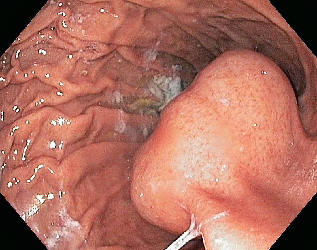 Gastrointestinal stromal tumour, endoscope view