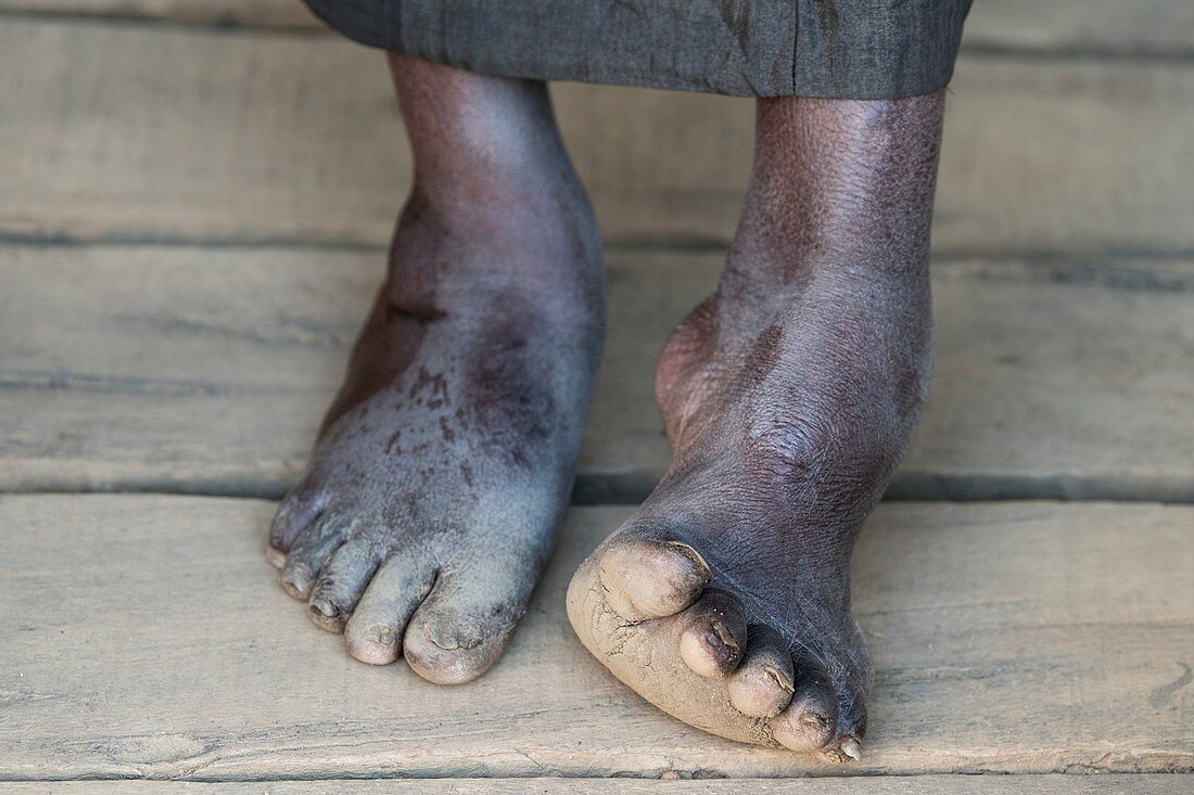 Club foot of a Malagasy woman.