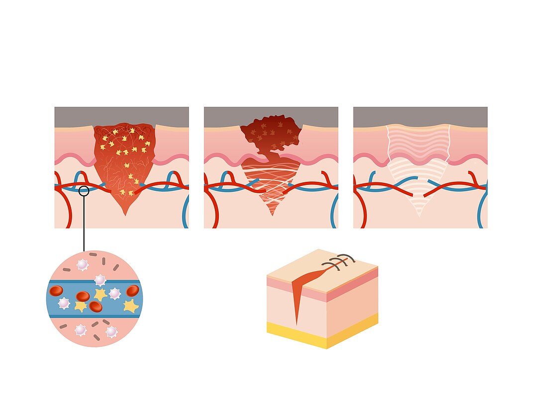 Wound healing, illustration