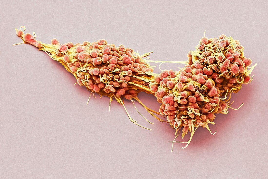Ovarian cancer cells, sem