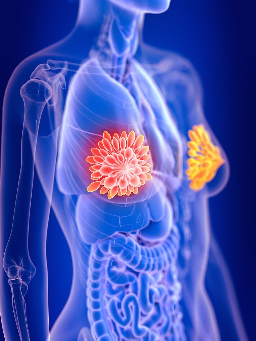 Illustration of female mammary glands cancer