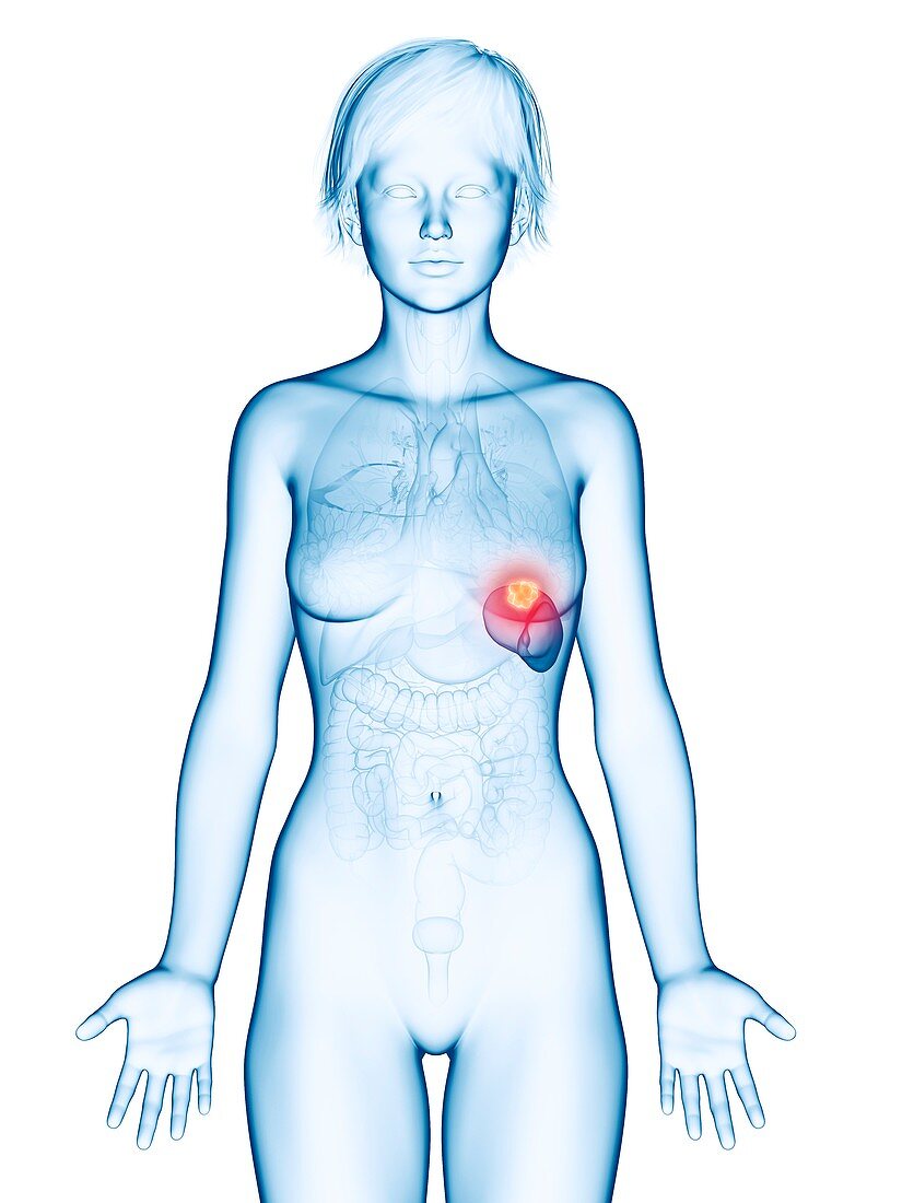 Illustration of spleen cancer