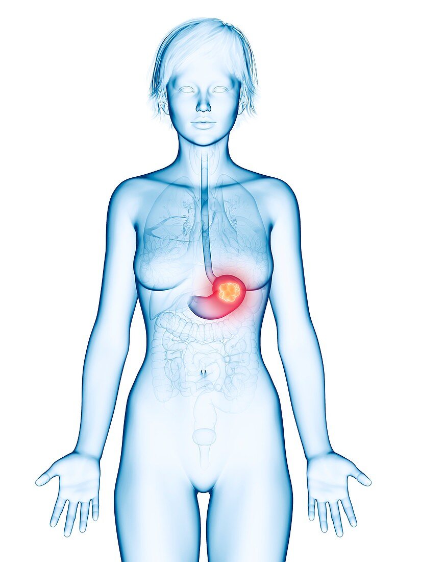 Illustration of stomach cancer