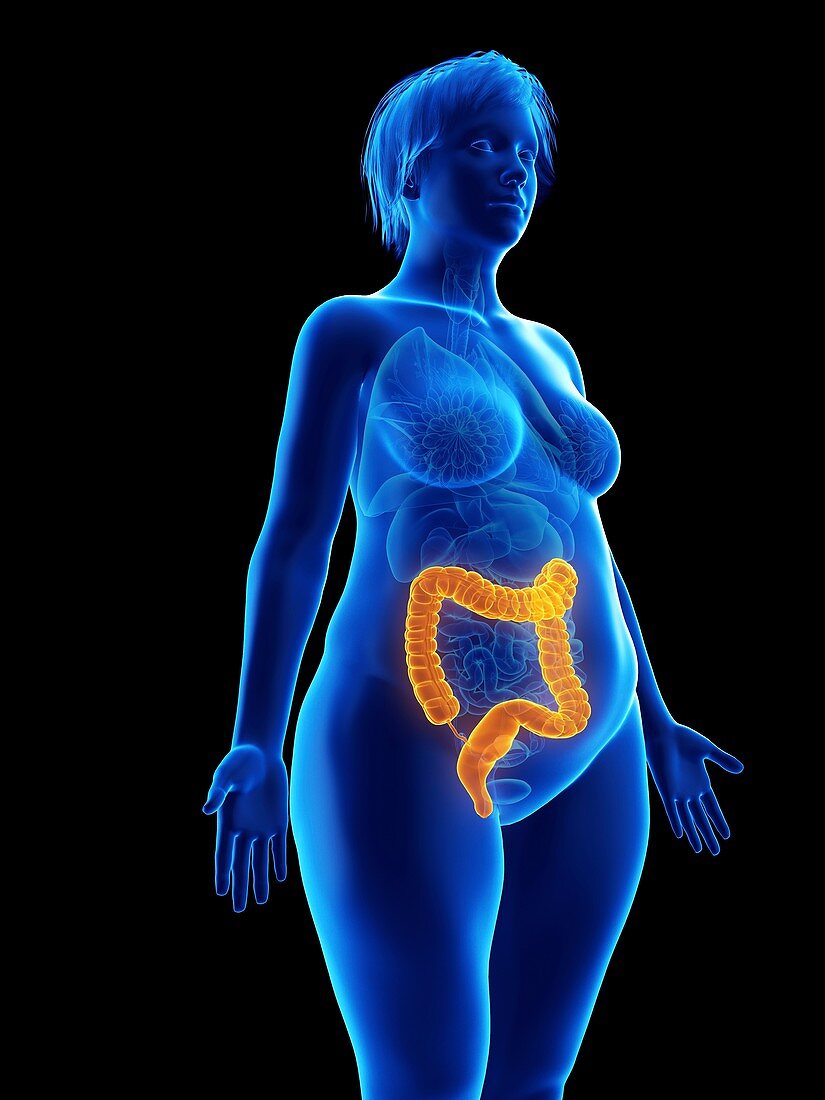 Illustration of an obese woman's colon