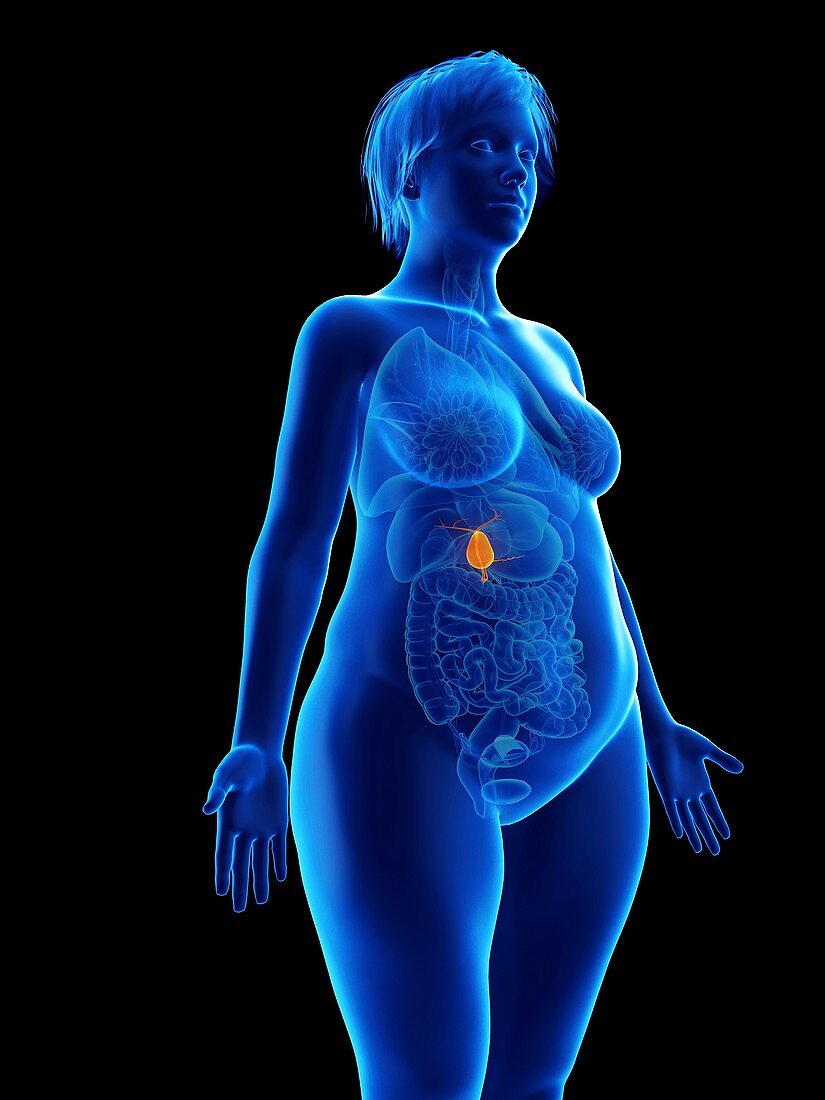 Illustration of an obese woman's gallbladder