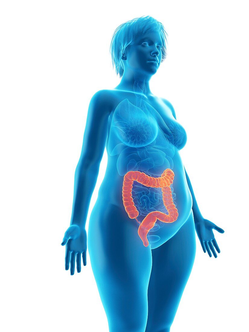 Illustration of an obese woman's colon