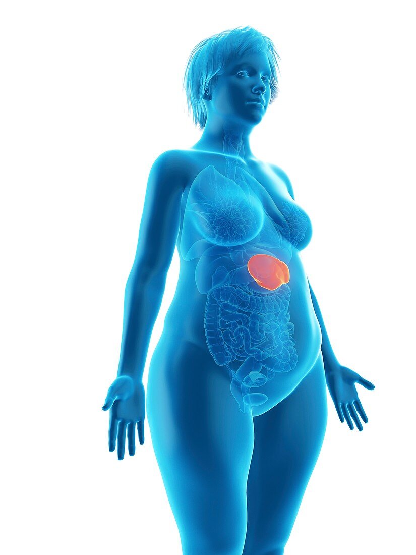 Illustration of an obese woman's spleen