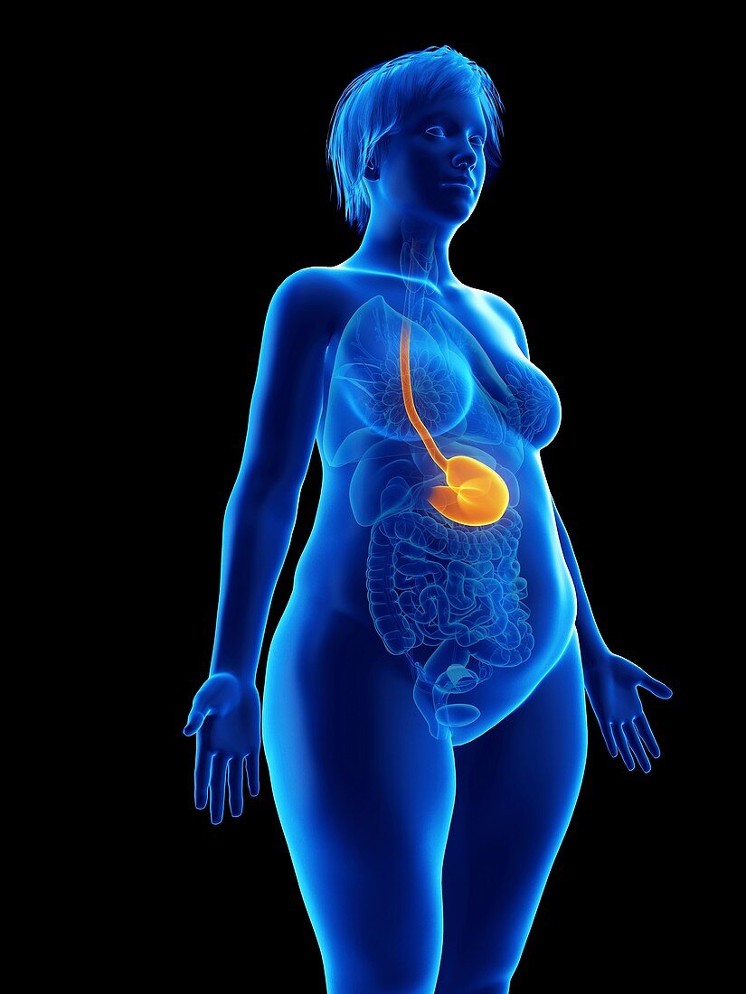 Illustration of an obese woman's stomach