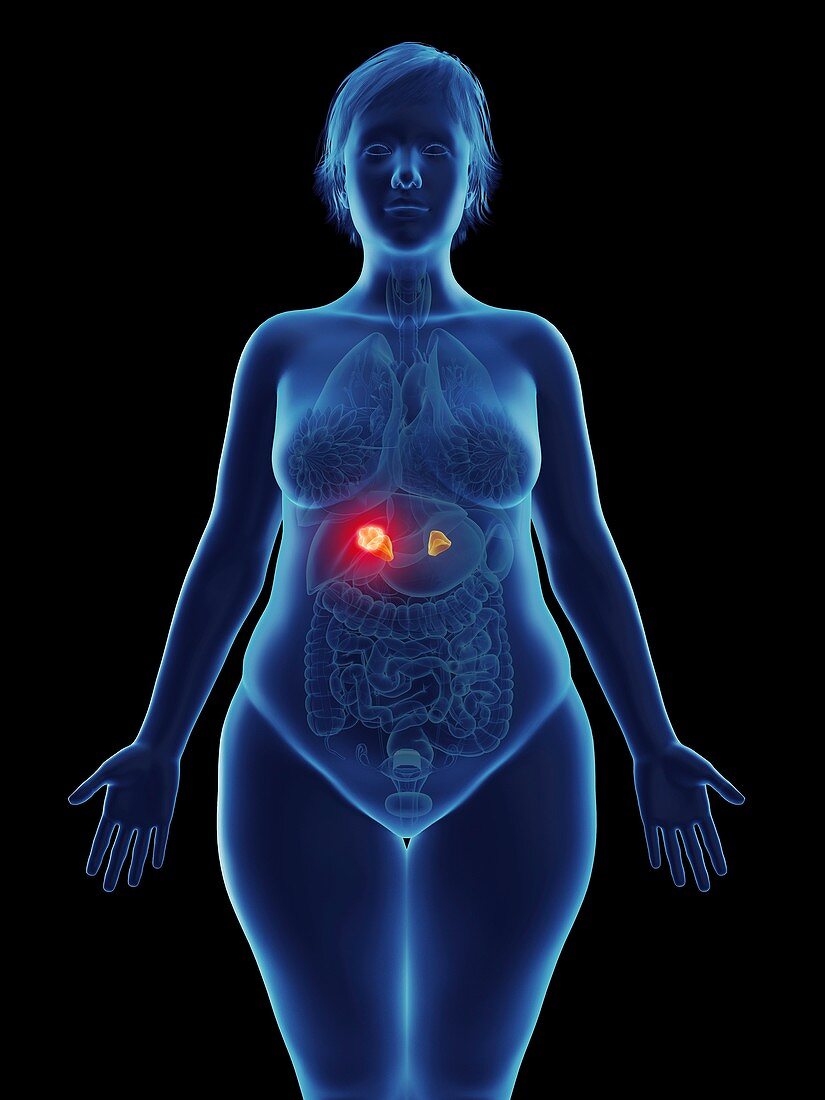 Illustration of a tumour in a woman's adrenal gland