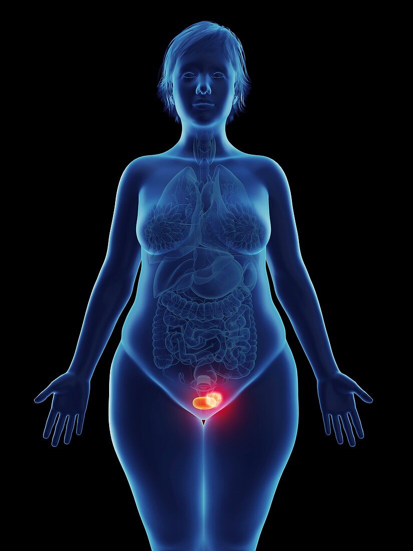 Illustration of a tumour in a woman's bladder