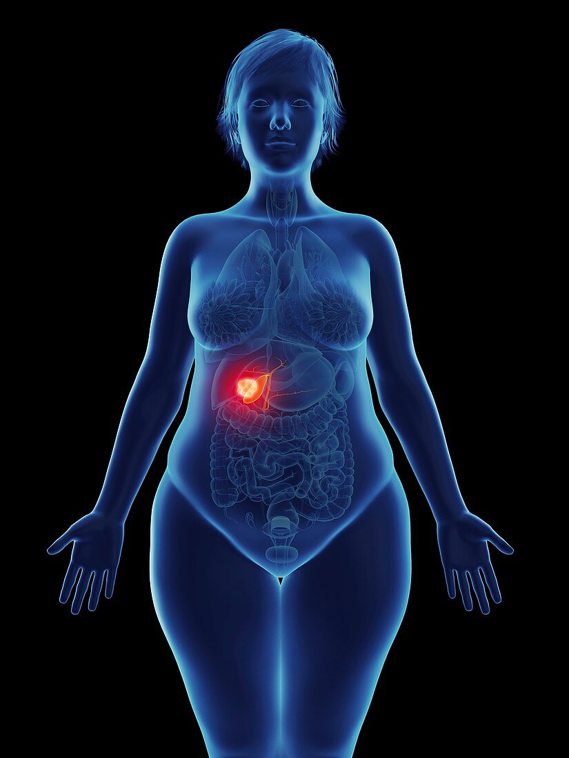 Illustration of a tumour in a woman's gallbladder