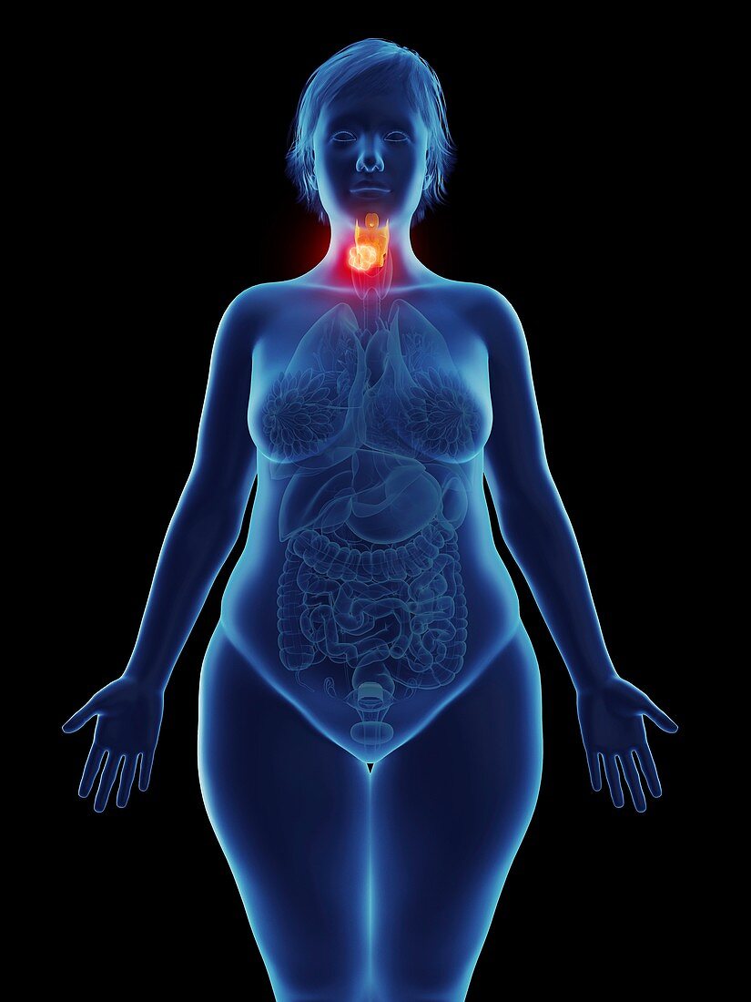 Illustration of a tumour in a woman's larynx