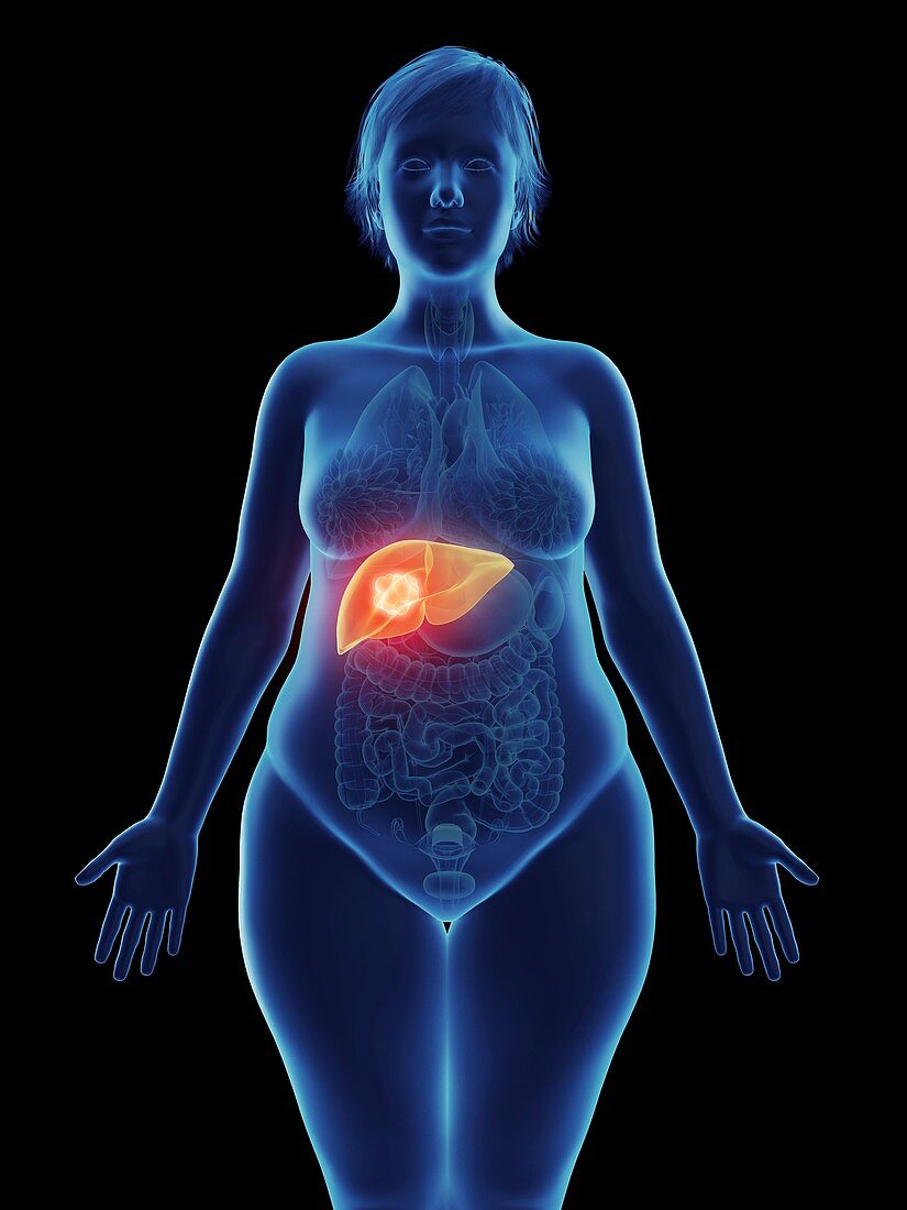 Illustration of a tumour in a woman's tumour