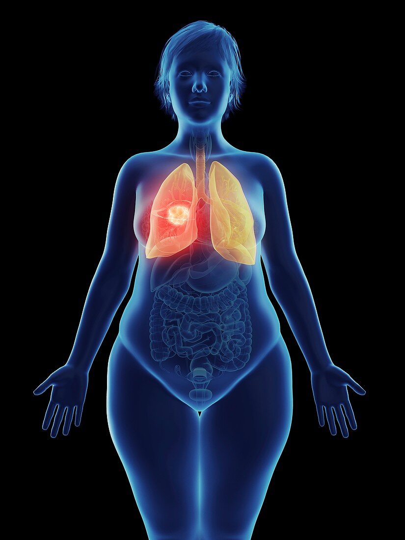 Illustration of a tumour in a woman's lung