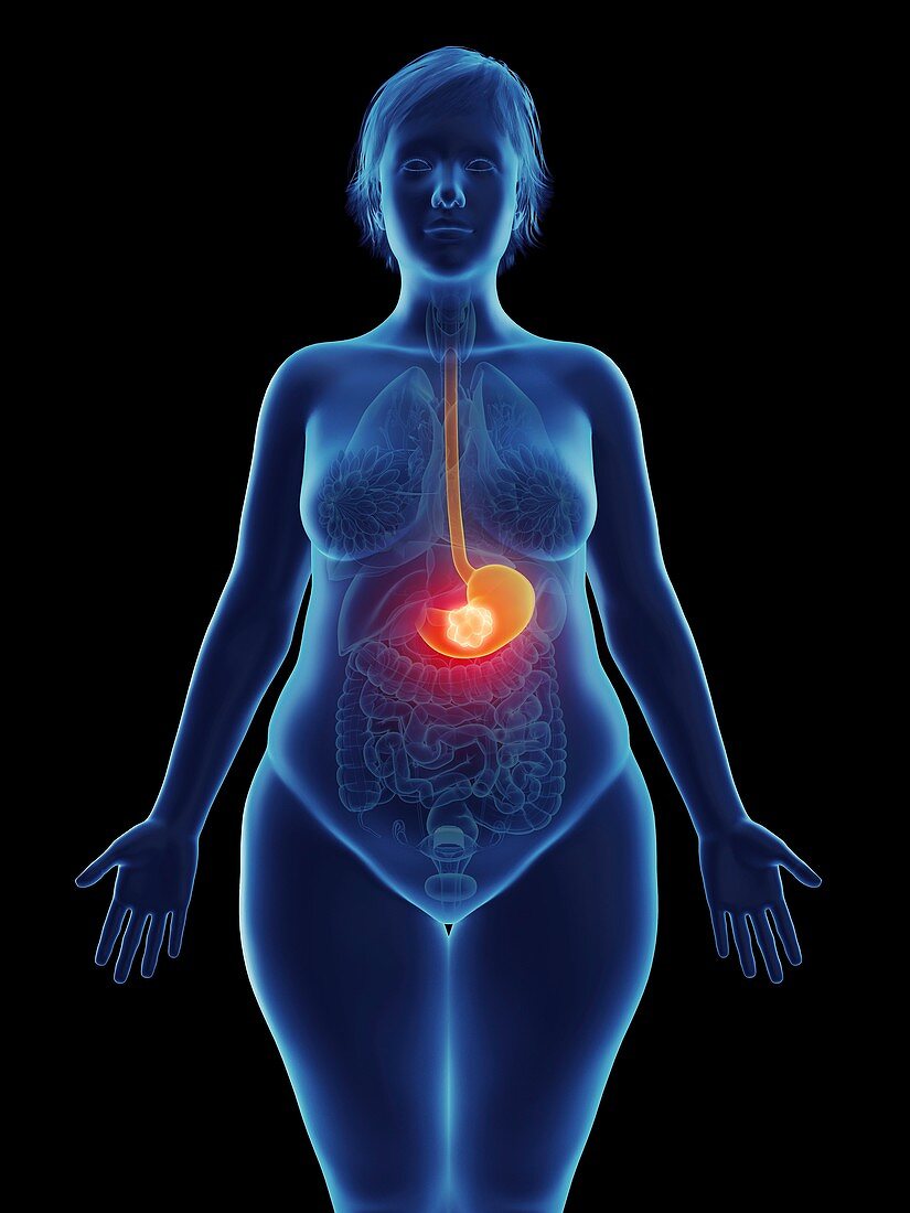 Illustration of a tumour in a woman's stomach