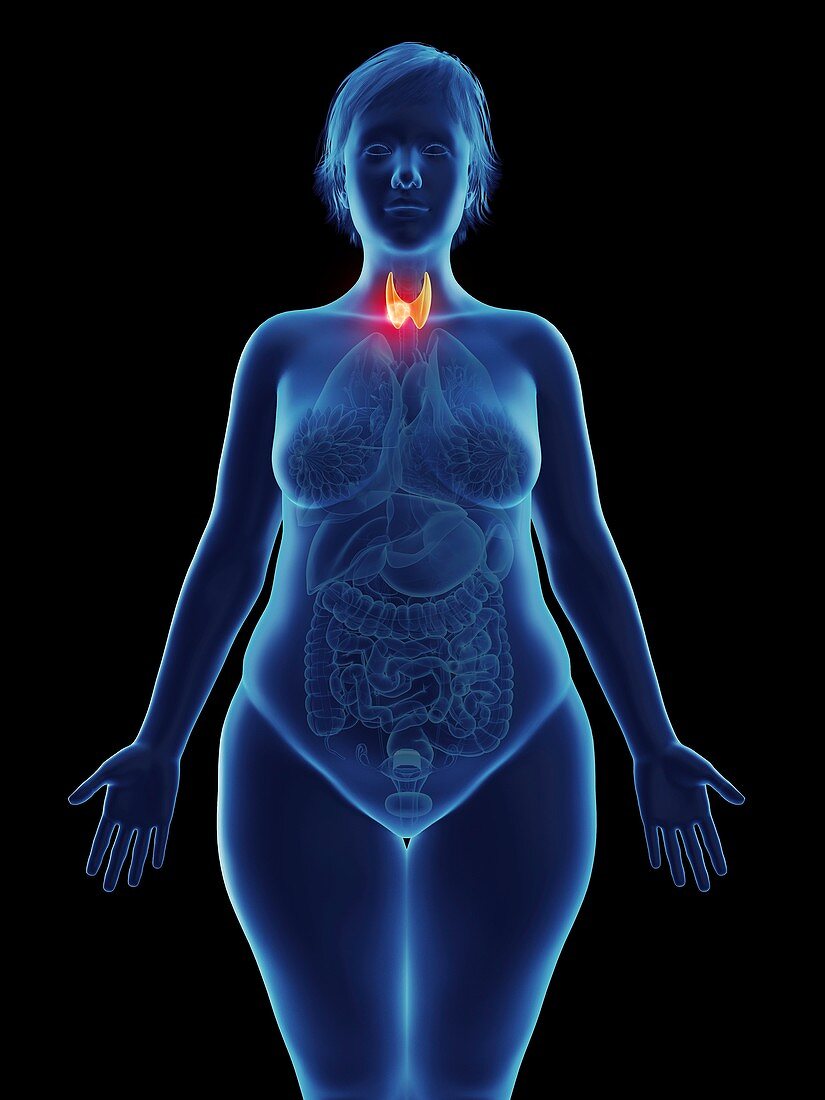 Illustration of a tumour in a woman's thyroid gland