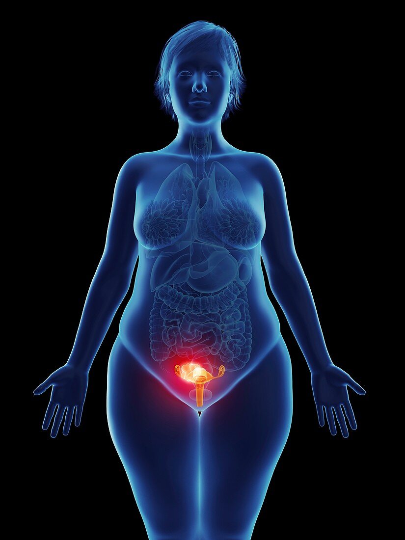 Illustration of a tumour in a woman's uterus