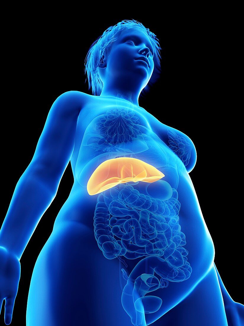 Illustration of an obese woman's liver