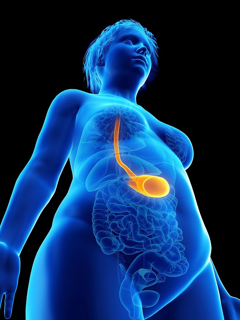 Illustration of an obese woman's stomach