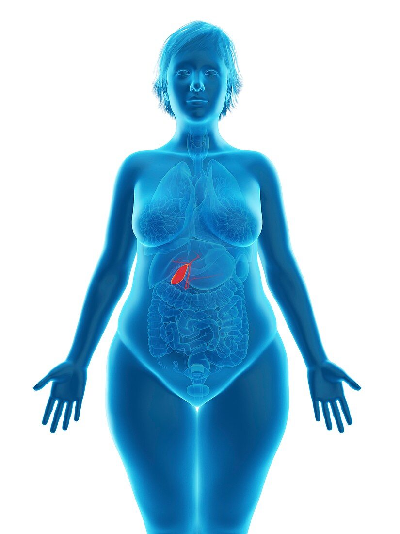 Illustration of an obese woman's gallbladder