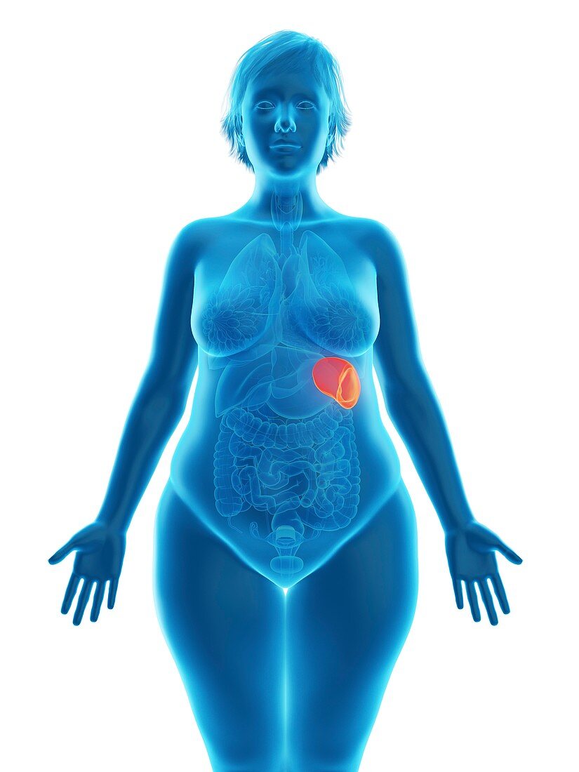 Illustration of an obese woman's spleen