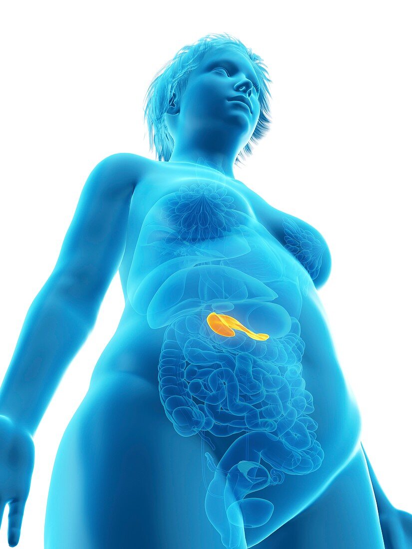 Illustration of an obese woman's pancreas