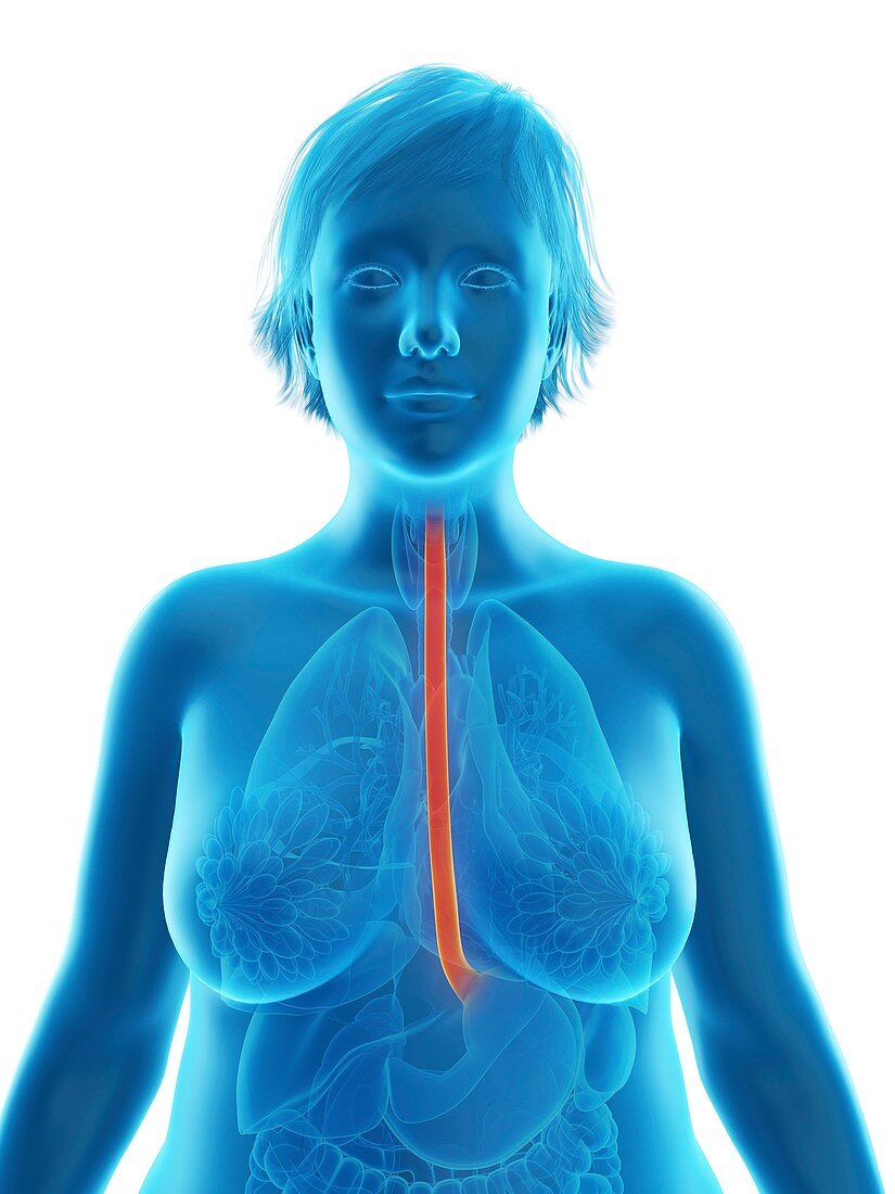 Illustration of an obese woman's esophagus