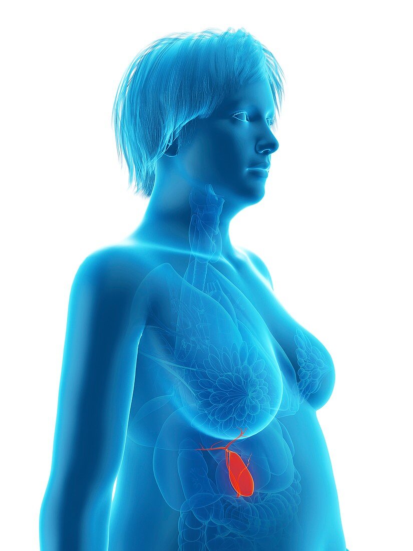 Illustration of an obese woman's gallbladder