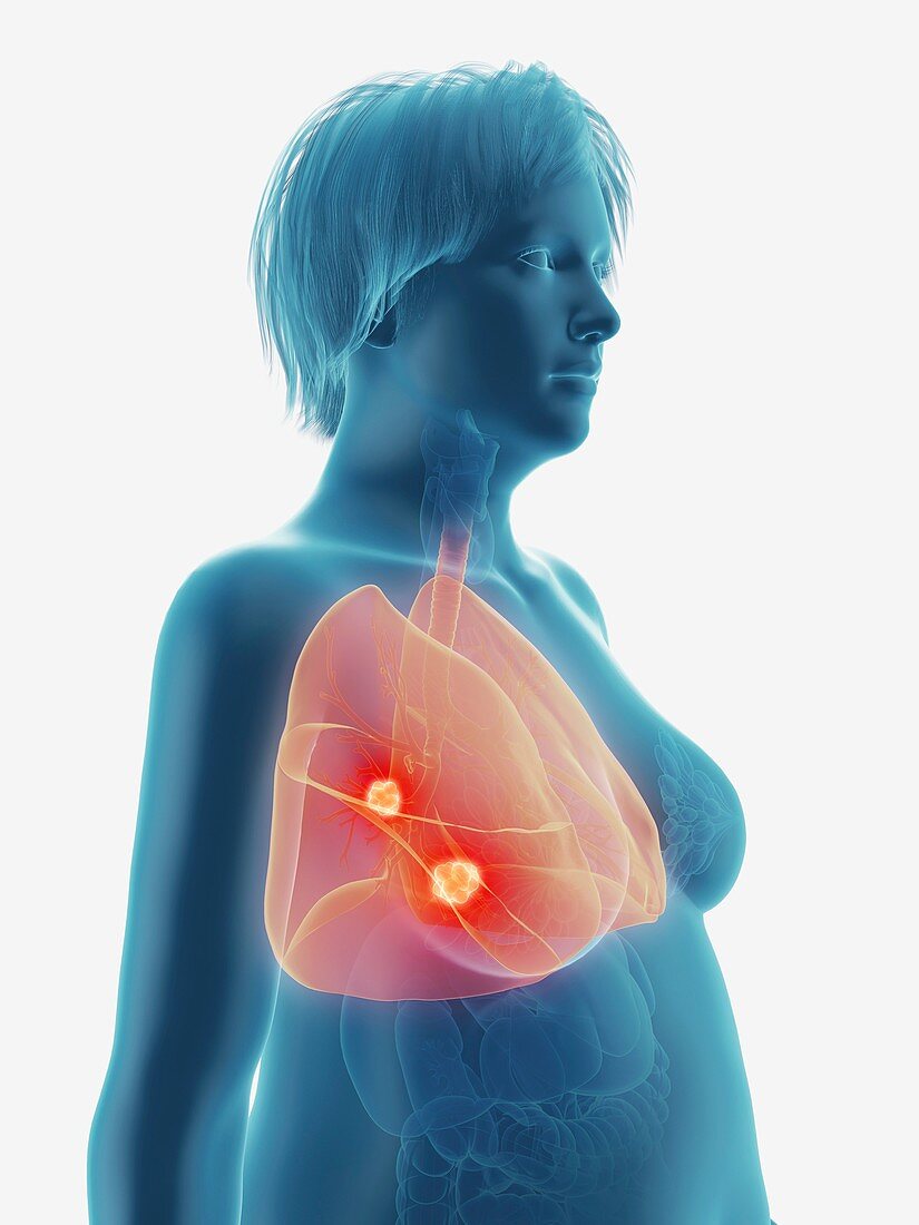 Illustration of a tumour in a woman's lung