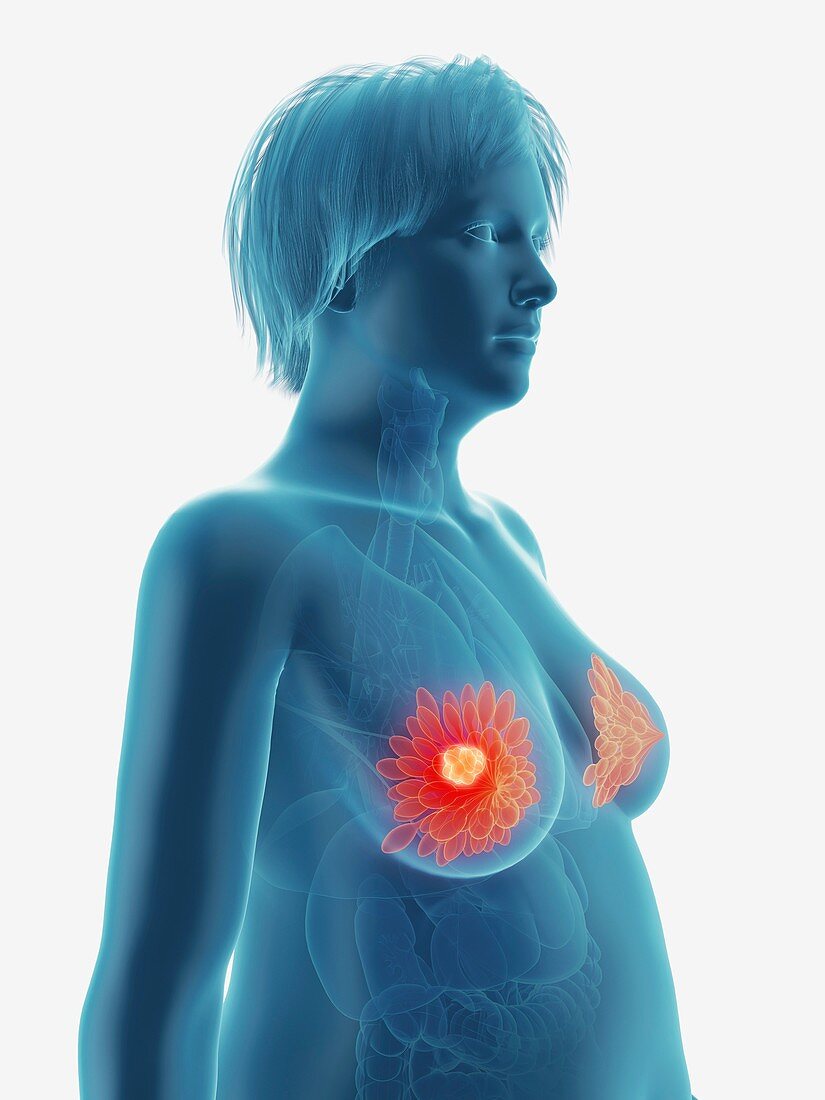 Illustration of a tumour in a woman's mammary glands