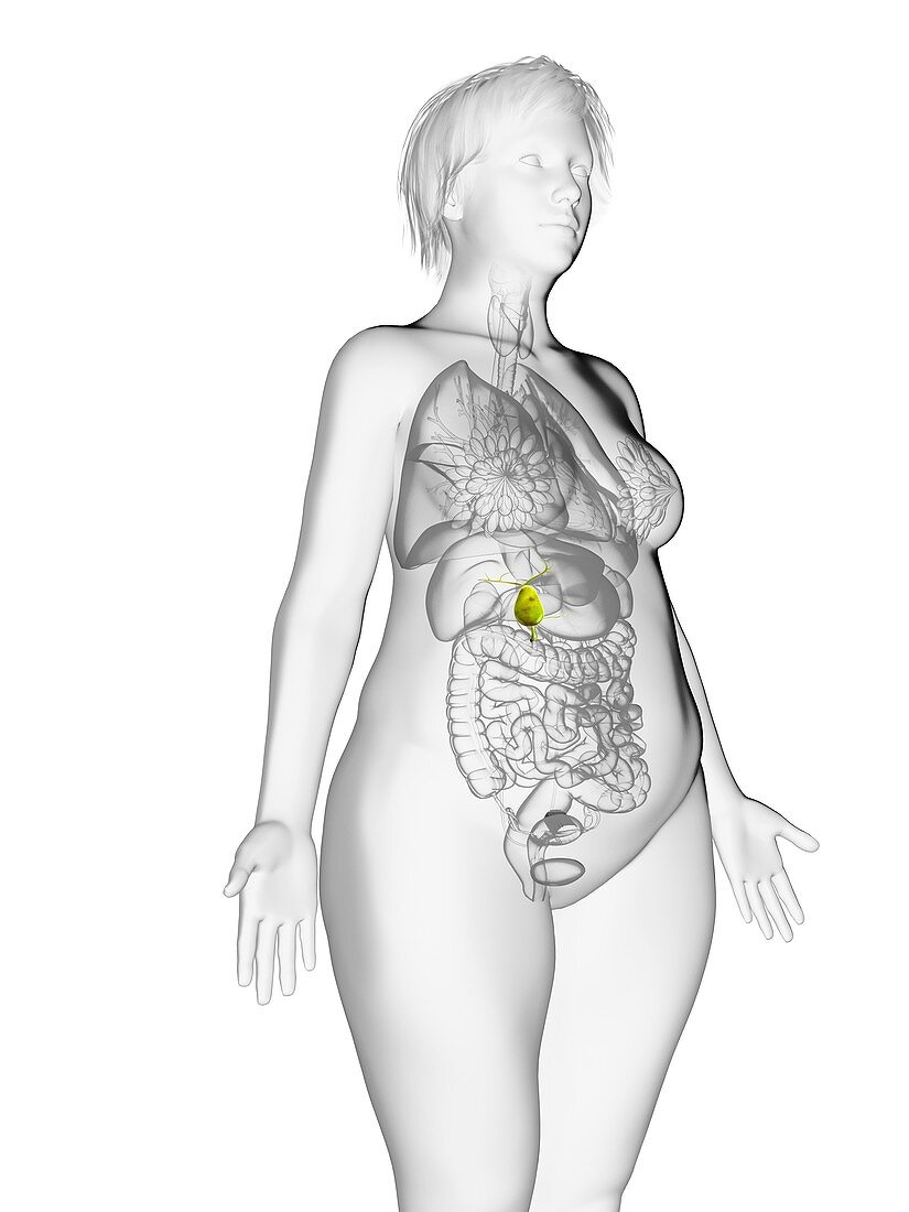 Illustration of an obese woman's gallbladder