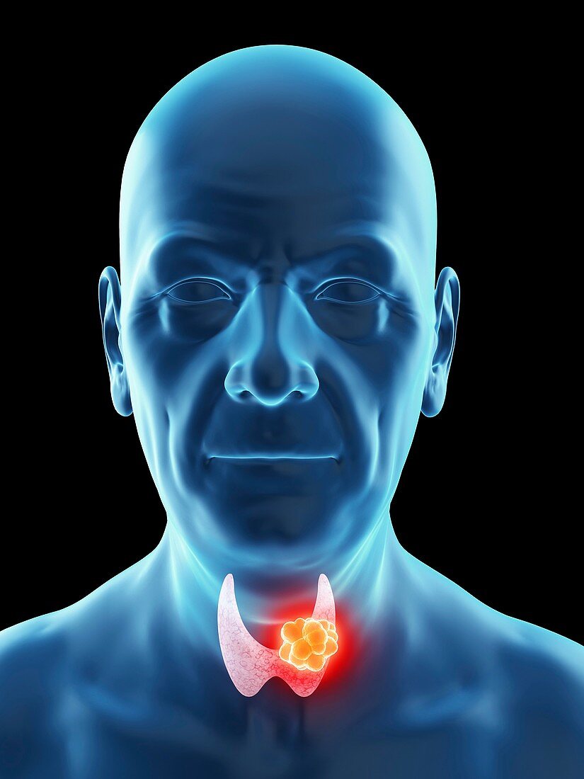 Illustration of an old man's thyroid gland cancer
