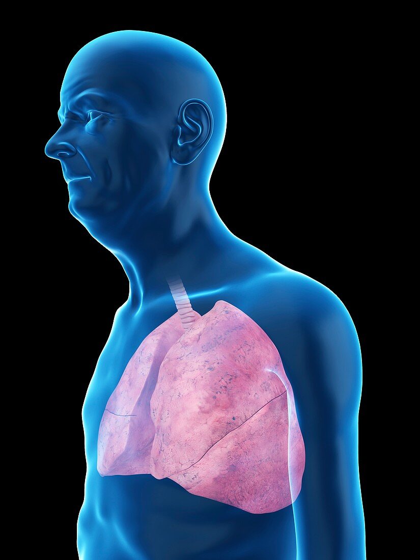 Illustration of an old man's lung