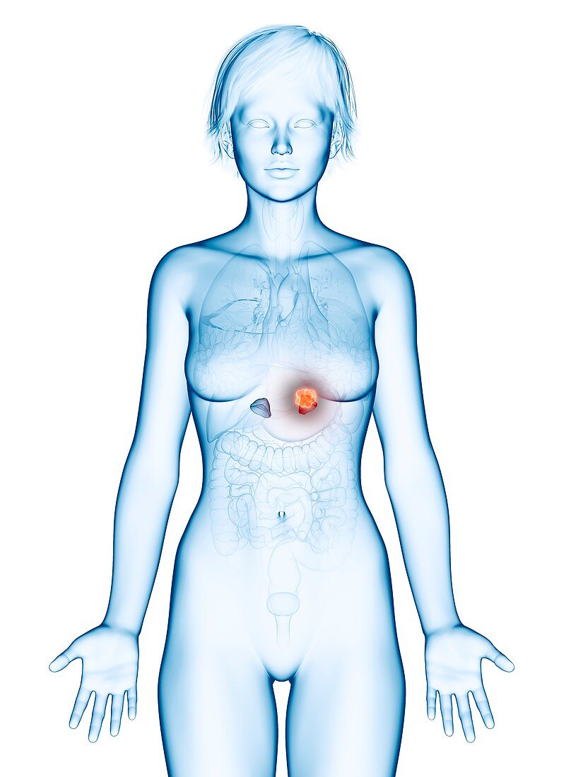 Illustration of adrenal gland cancer