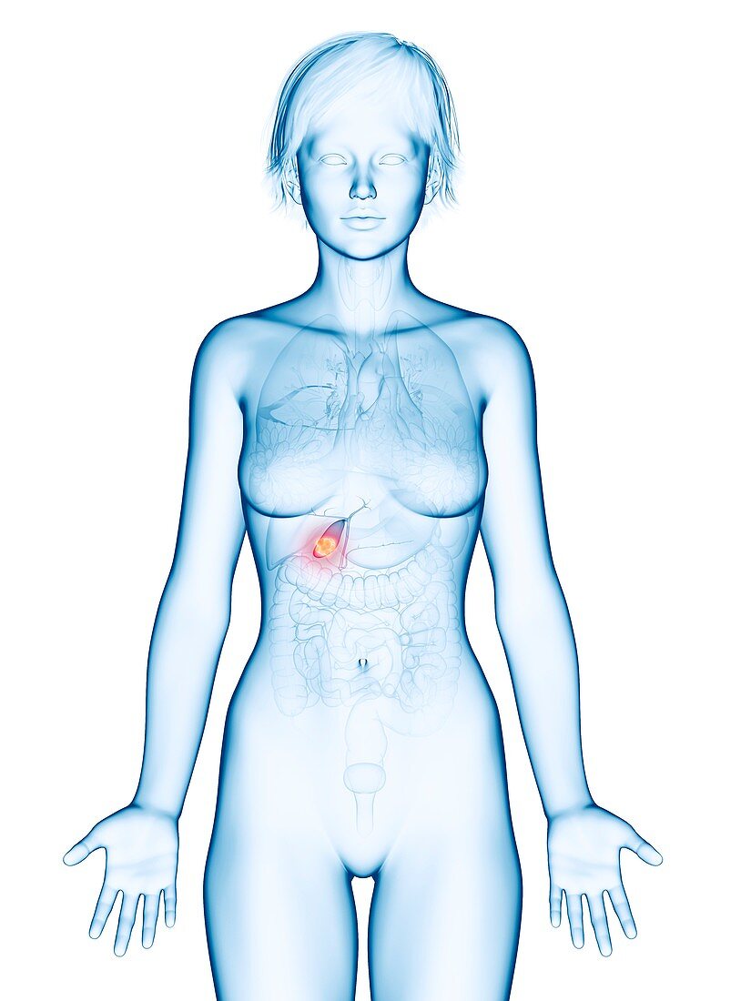 Illustration of gallbladder cancer