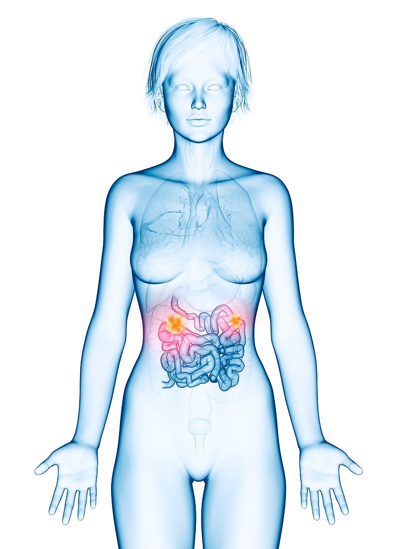 Illustration of small intestine cancer