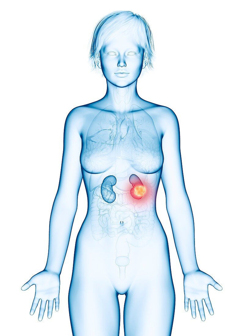 Illustration of kidneys cancer